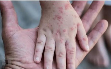 Bệnh Đậu mùa Khỉ: Triệu chứng và các biện pháp phòng bệnh