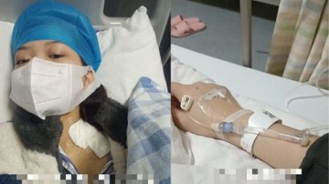 Cô gái 18 tuổi đã chạy thận suốt đời: Bác sĩ cảnh báo các dấu hiệu sớm cho thấy thận ‘kêu cứu’