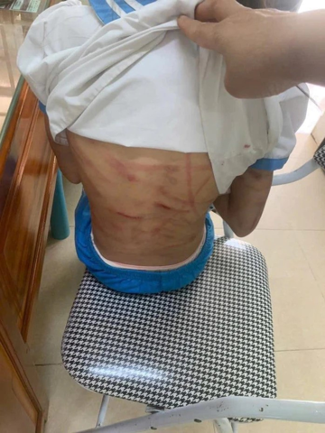 Bé gái lớp 5 nghi bị cha dượng bạo hành: Vùng đầu chảy máu, chân khó cử động