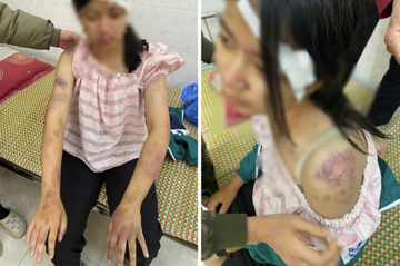 Công an khẩn trương xác minh vụ bé gái 13 tuổi bị ông bà nội tra tấn dã man, phải nhập viện