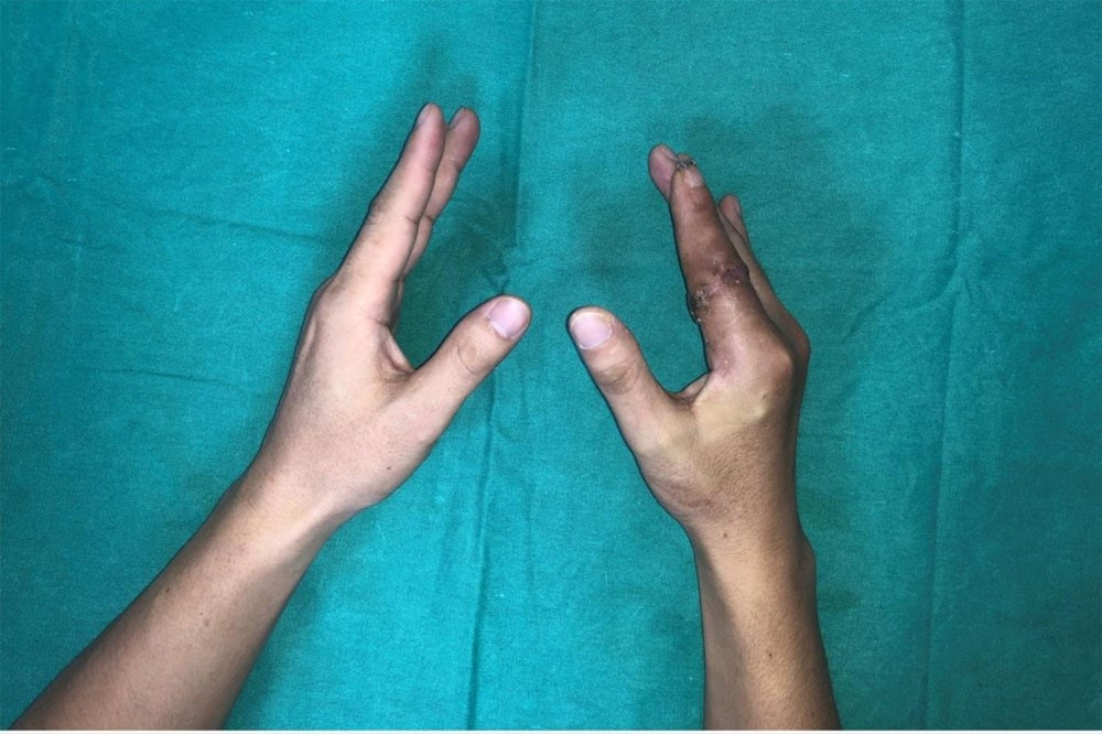 Kỳ tích y khoa lần đầu ghi nhận tại Việt Nam: Ngón tay đứt rời được cứu sống ngoạn mục sau 25 giờ - ảnh 2