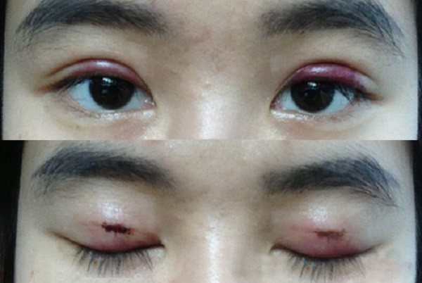 Cô gái 22 tuổi mù cả 2 mắt sau khi làm loại tiểu phẫu thẩm mỹ được nhiều chị em chuộng - ảnh 2