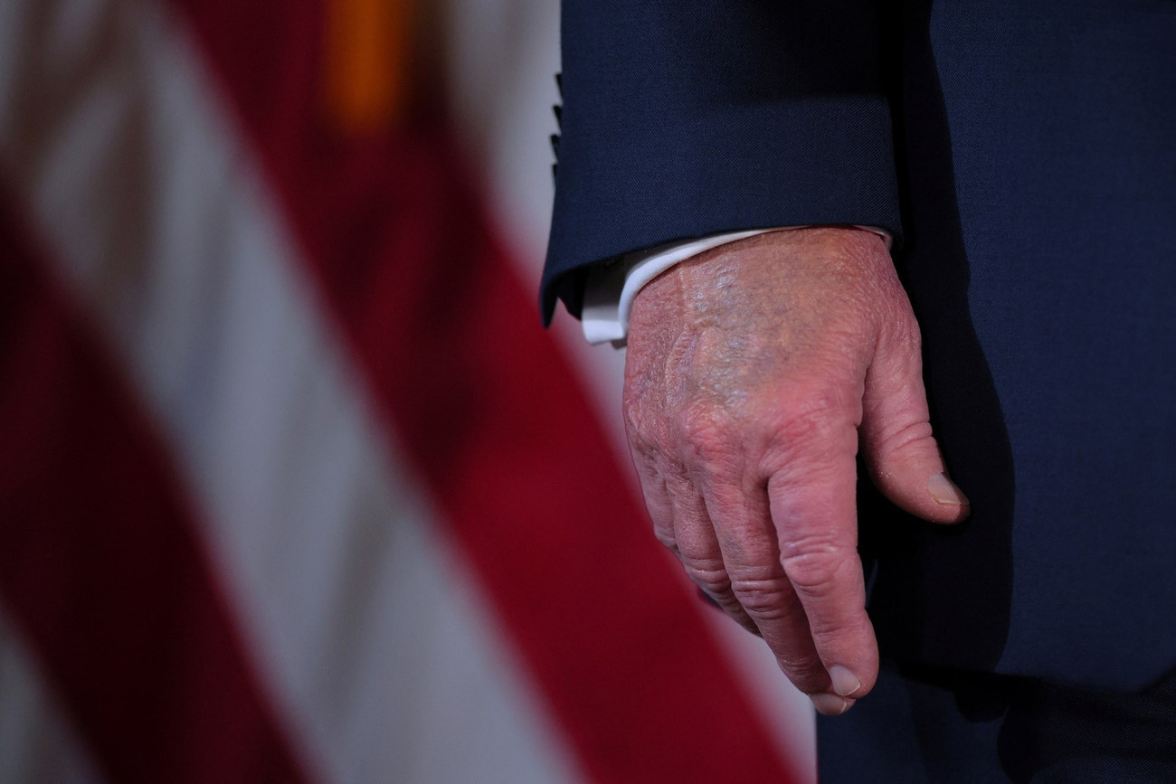 Hình ảnh cho thấy mu bàn tay của ông Trump bị bầm tím. (Ảnh: Reuters) mqamndvdjrl27ep7sq5fsoekfm.jpg