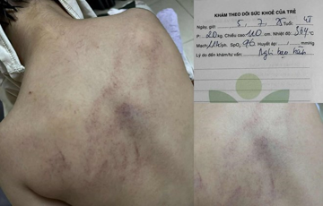 Tạm đình chỉ cô giáo mầm non đánh đập, kéo lê, ném bé gái 4 tuổi vào tường