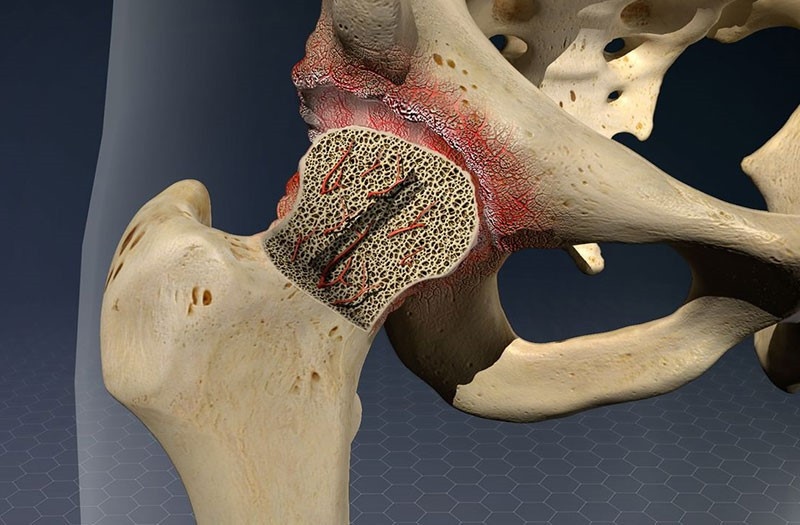 Người từng mắc Covid-19 có nguy cơ bị hoại tử xương - ảnh 2