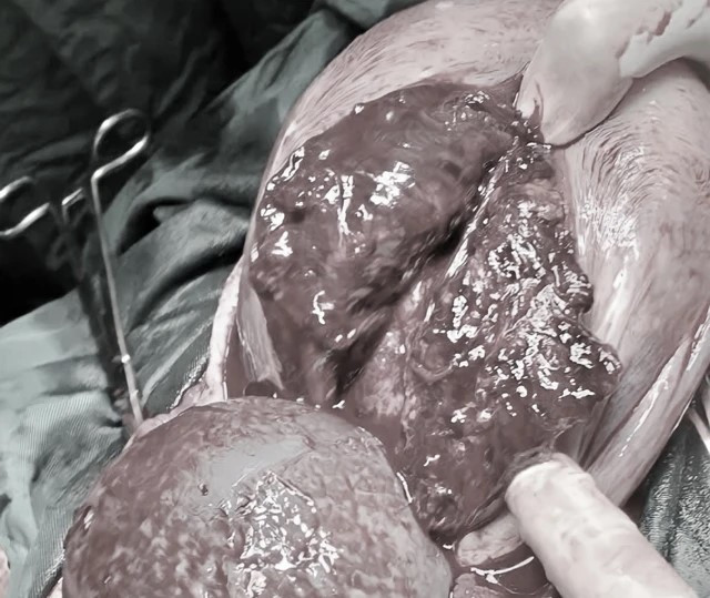 Tự ý phá thai tại nhà ở tuần thứ 33, thai phụ vỡ tử cung, 3 lít máu tràn vào ổ bụng - ảnh 1