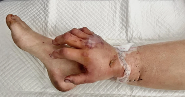 Ca phẫu thuật hy hữu: Nuôi sống bàn tay trên chân bệnh nhân, chờ ngày ghép lại tay