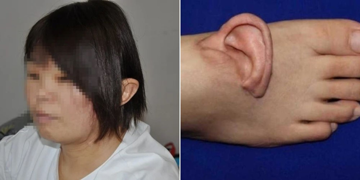 Chưa từng có trong lịch sử: Ca ghép tai người vào chân đầu tiên trên thế giới thành công, đánh dấu bước đột phá trong y học tái tạo
