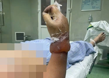 Dựng cây nêu ngày Tết, người phụ nữ có nguy cơ phải cắt cụt cẳng tay vì điện giật