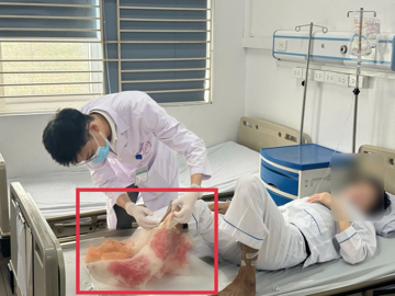 Đắp lá chữa bỏng suốt một tháng, người đàn ông suýt mất chân vì hoại tử lan tới xương